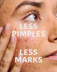 Prevent & Correct Anti-Blemish Serum