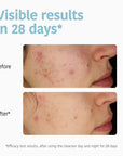 Purifying Anti-Blemish Cleansing Gel