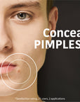 SOS Pimple Patches with Salicylic Acid