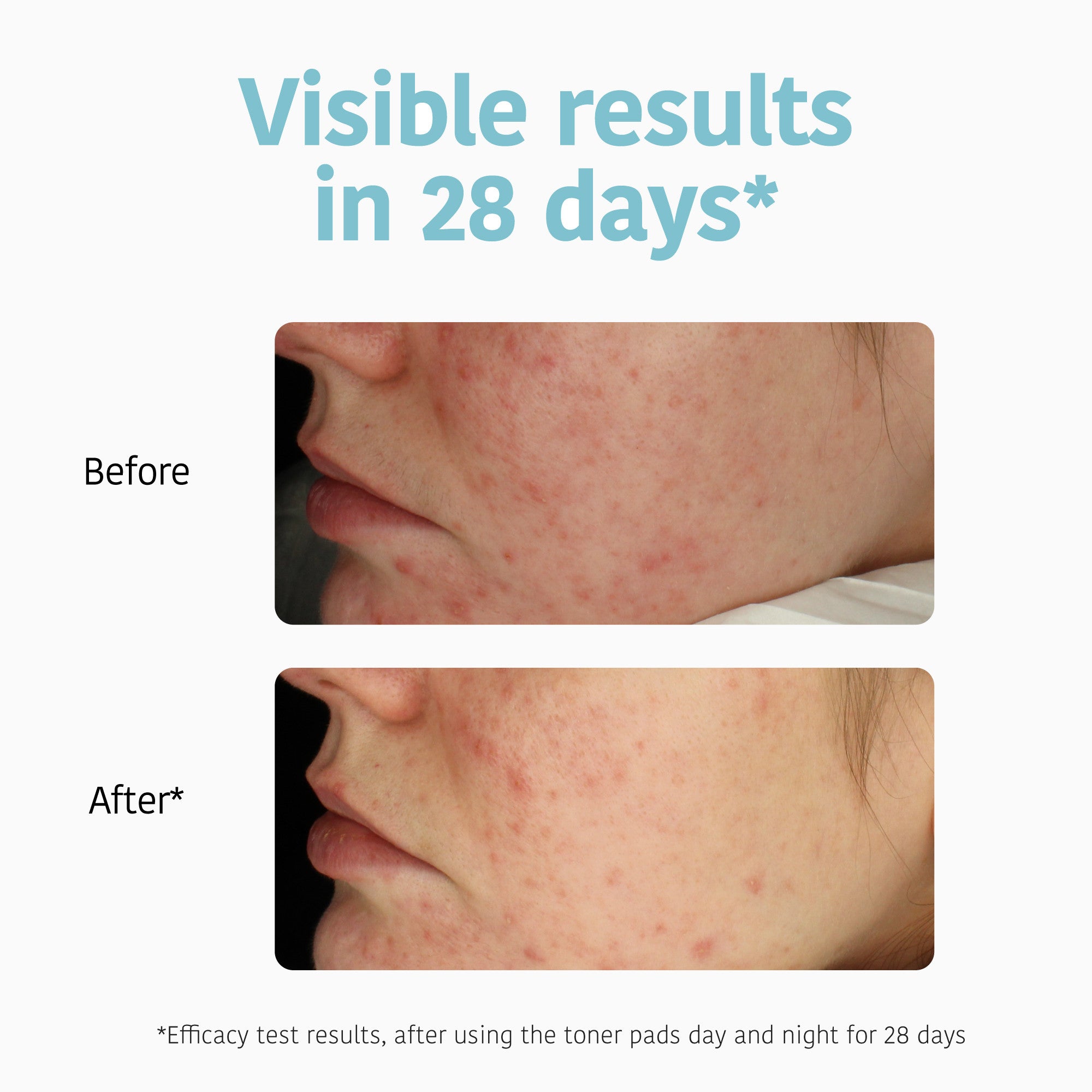 Exfoliating Anti-Blemish Toner Pads