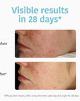 Exfoliating Anti-Blemish Toner Pads