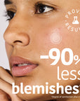 Microdarts Pimple Patches with Salicylic Acid