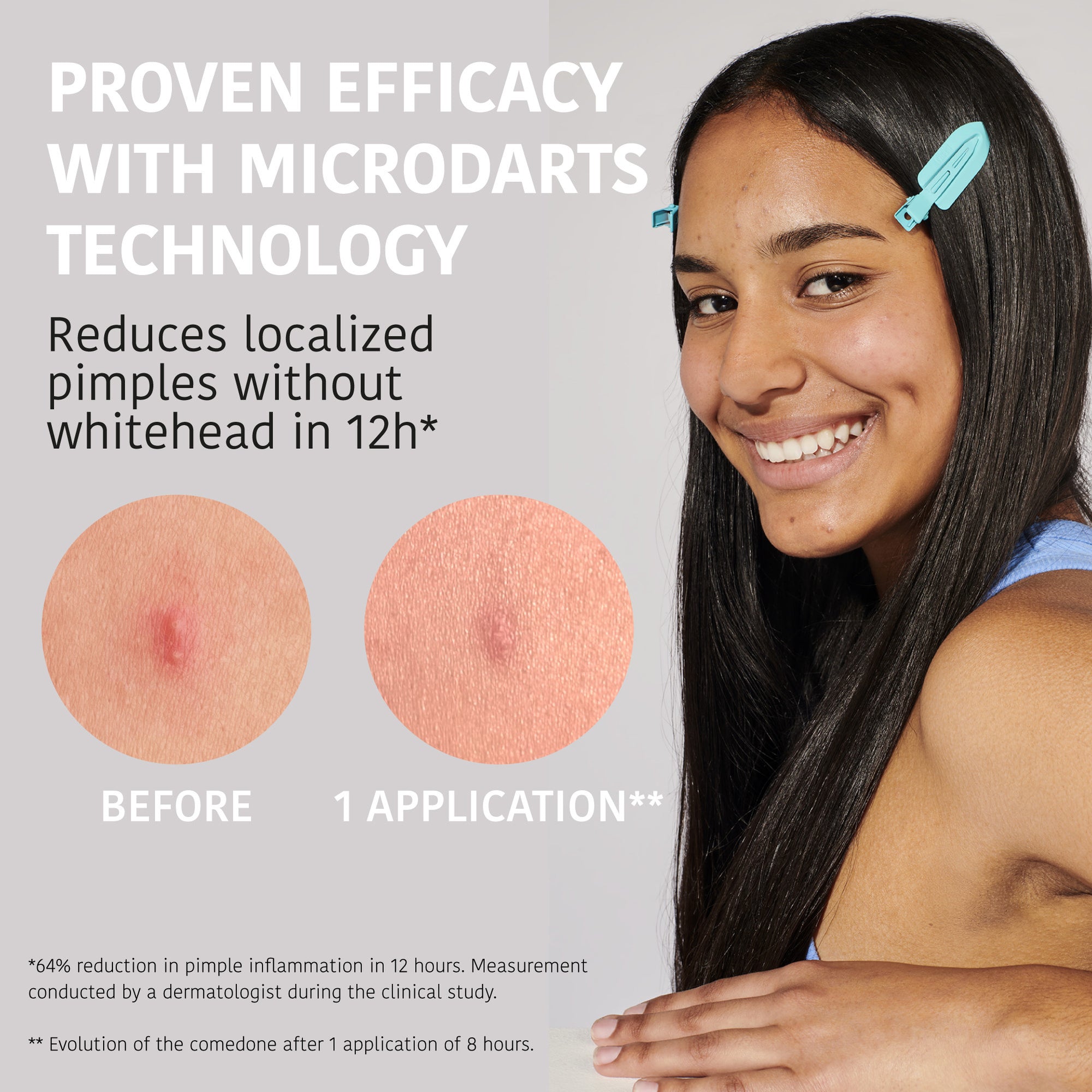 Microdarts Pimple Patches with Salicylic Acid