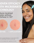 Microdarts Pimple Patches with Salicylic Acid