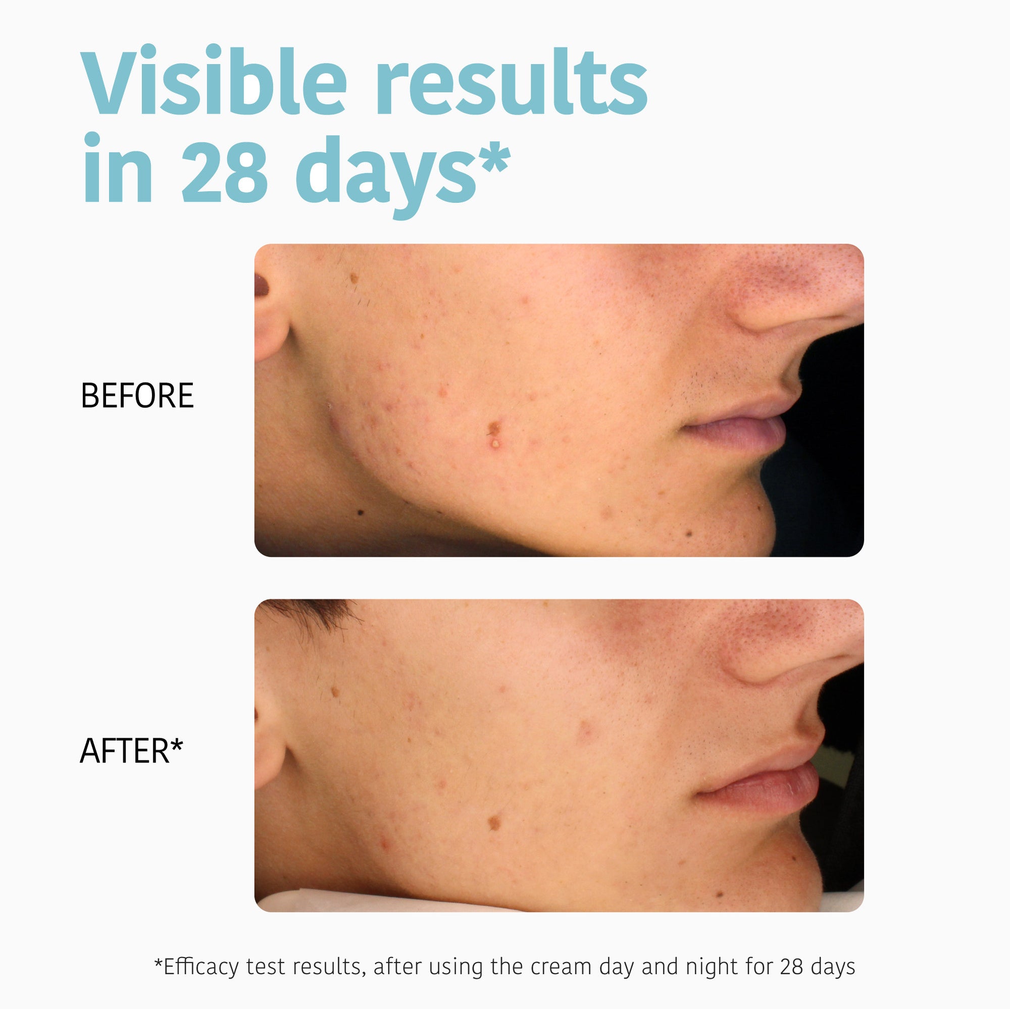 Oil Control Anti-Blemish Cream