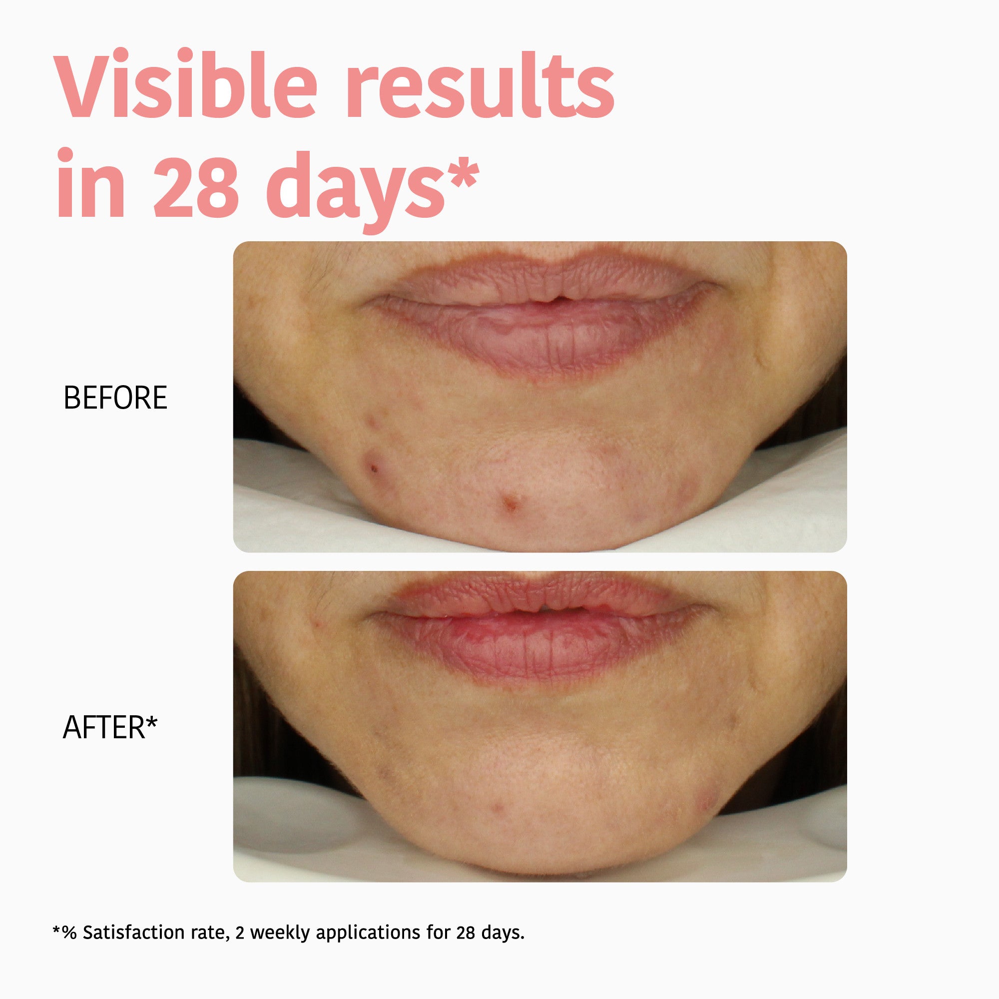 Perfect Skin Peeling Face Sheet Mask with Glycolic Acid