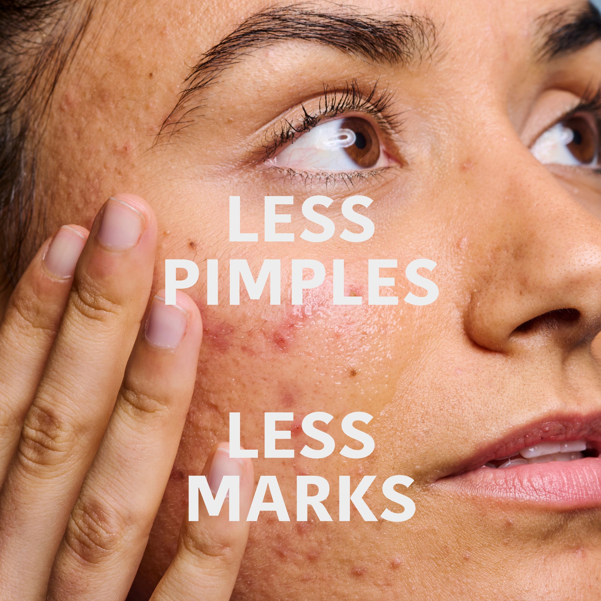 Prevent &amp; Correct Anti-Blemish Serum