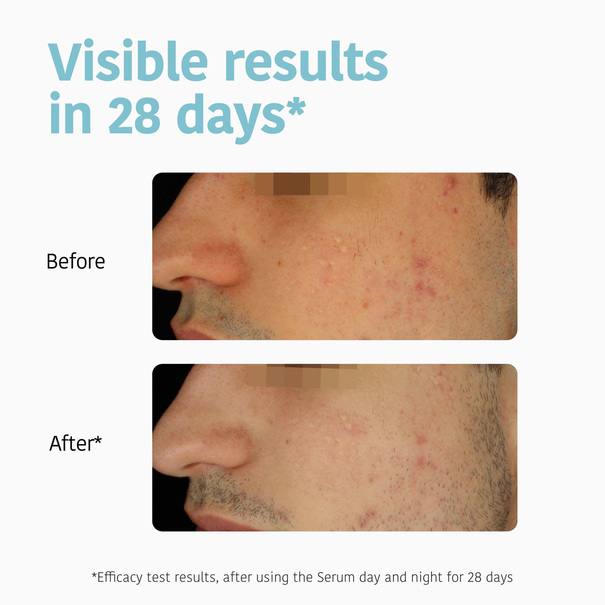 Prevent &amp; Correct Anti-Blemish Serum