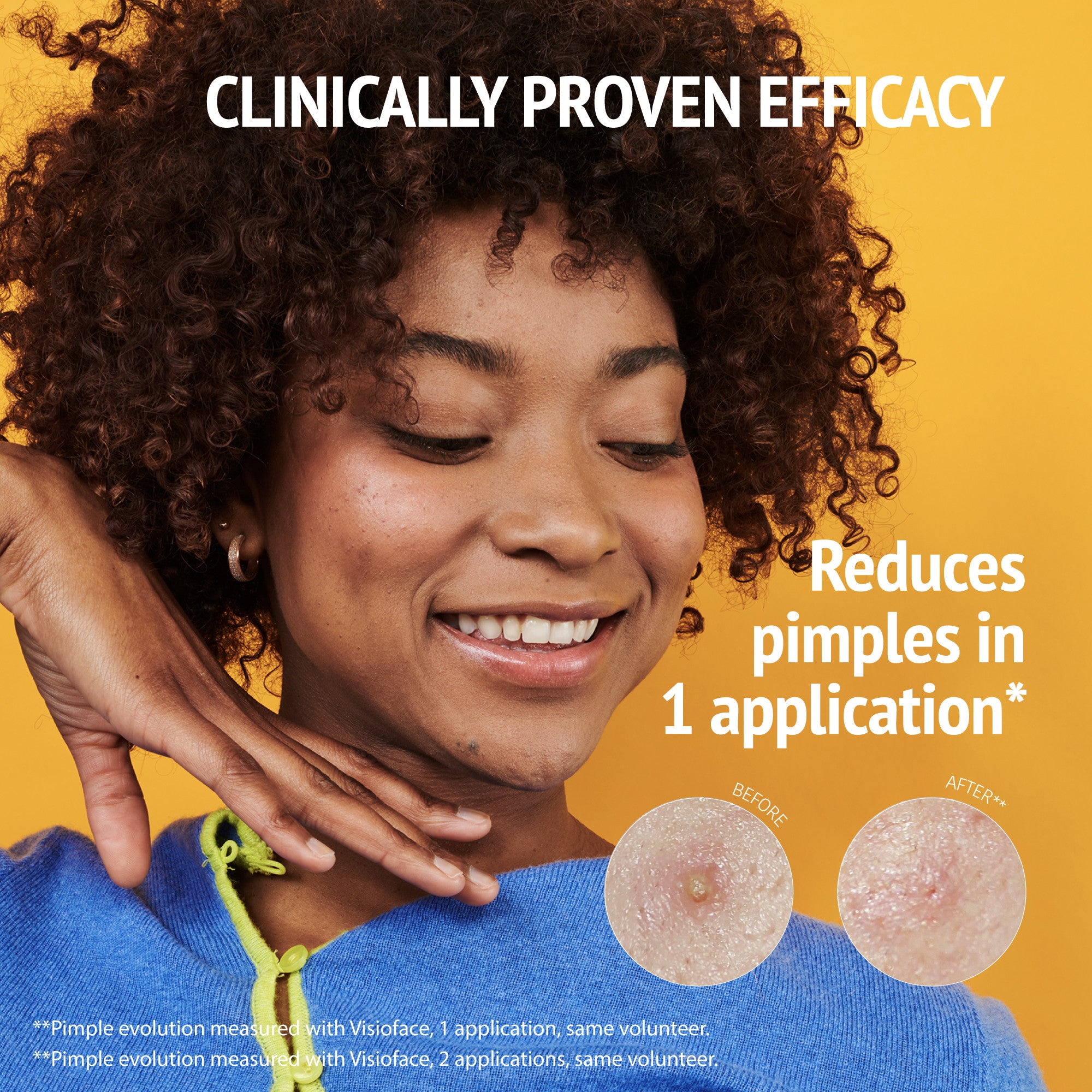 PRIDE Pimple Patches with Salicylic Acid