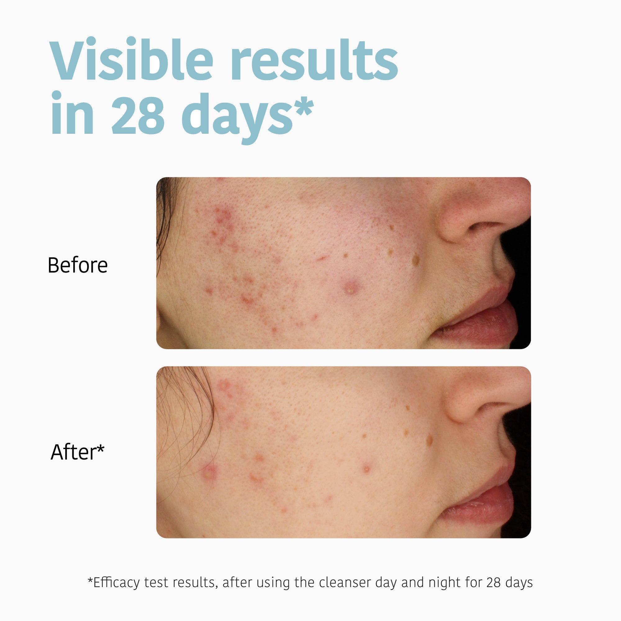 Purifying Anti-Blemish Cleansing Gel