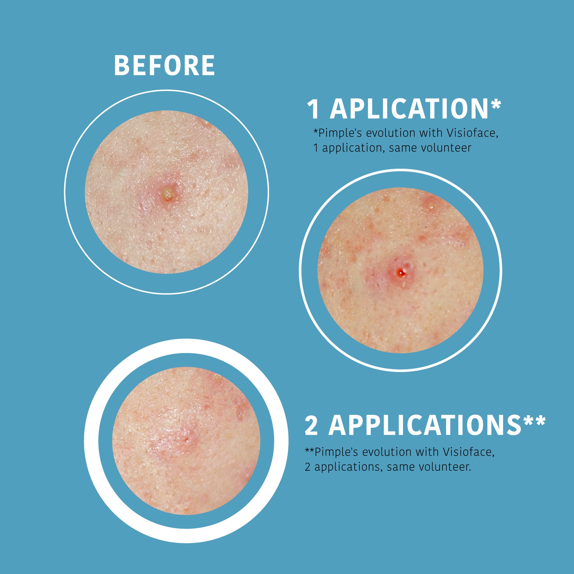 SOS Pimple Patches with Salicylic Acid