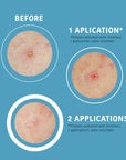 SOS Pimple Patches with Salicylic Acid