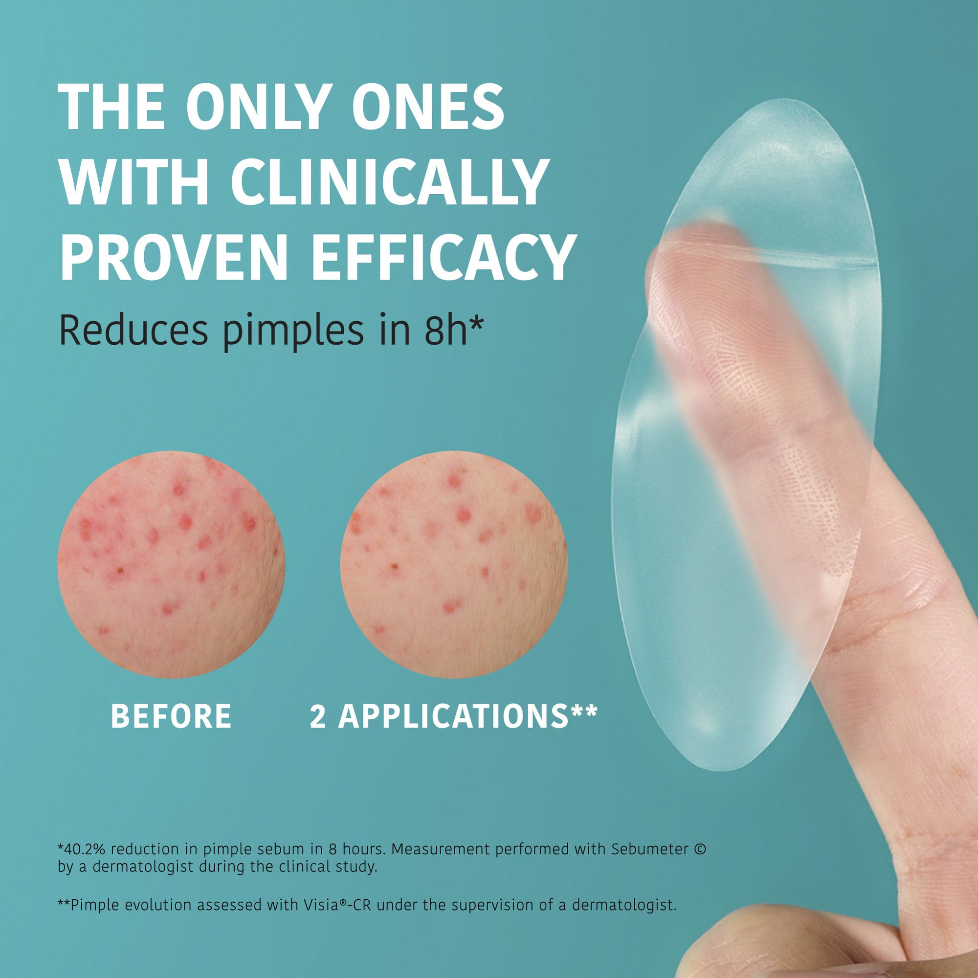 XL Pimple Patches with Salicylic Acid
