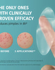 XL Pimple Patches with Salicylic Acid